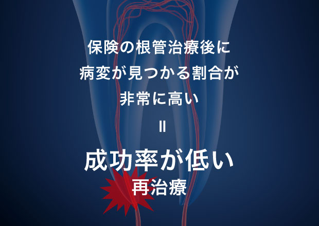 保険の根管治療後に病変が見つかる割合が非常に高い=成功率が低い